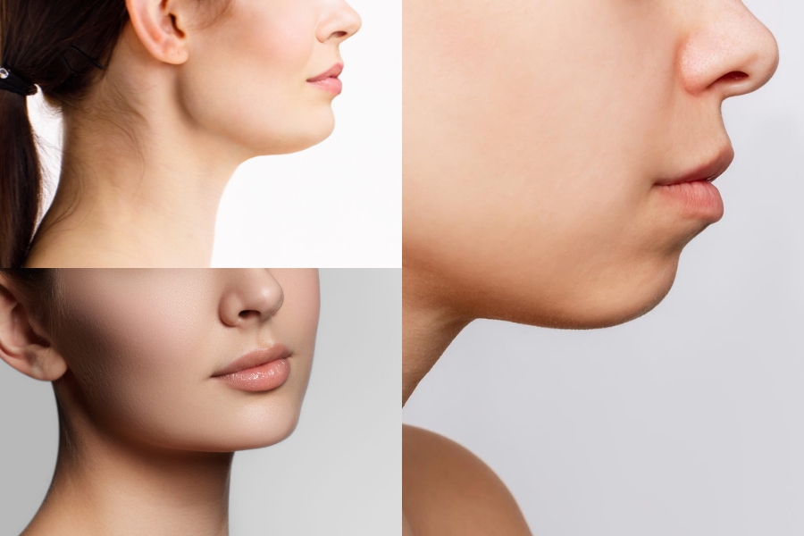 Những dáng cằm nên thực hiện độn cằm V line