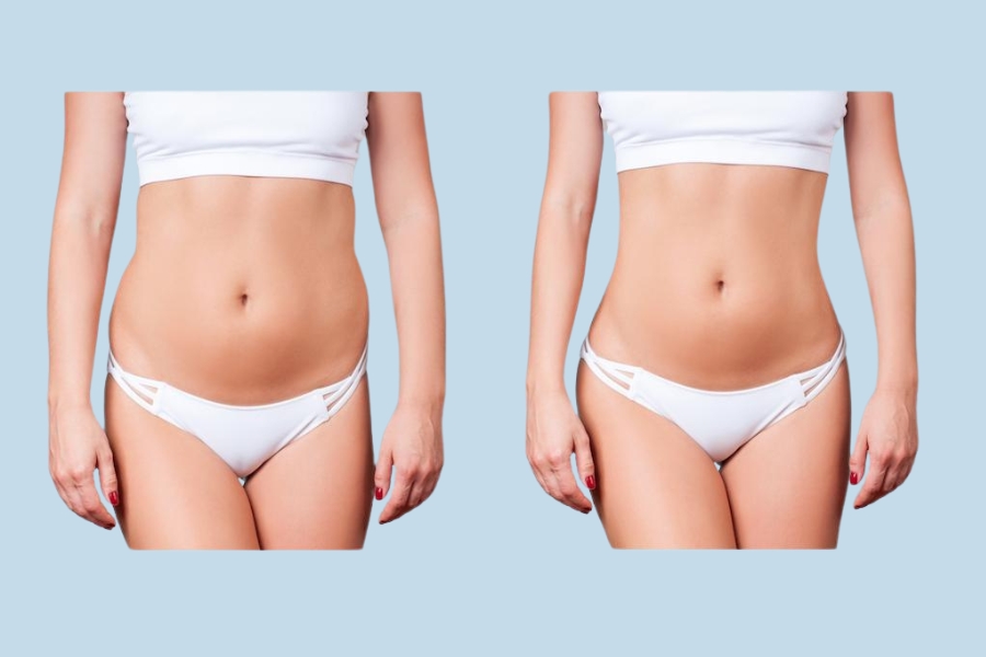 Hút mỡ toàn thân giúp loại bỏ mỡ thừa cứng đầu một cách nhanh chóng, hiệu quả