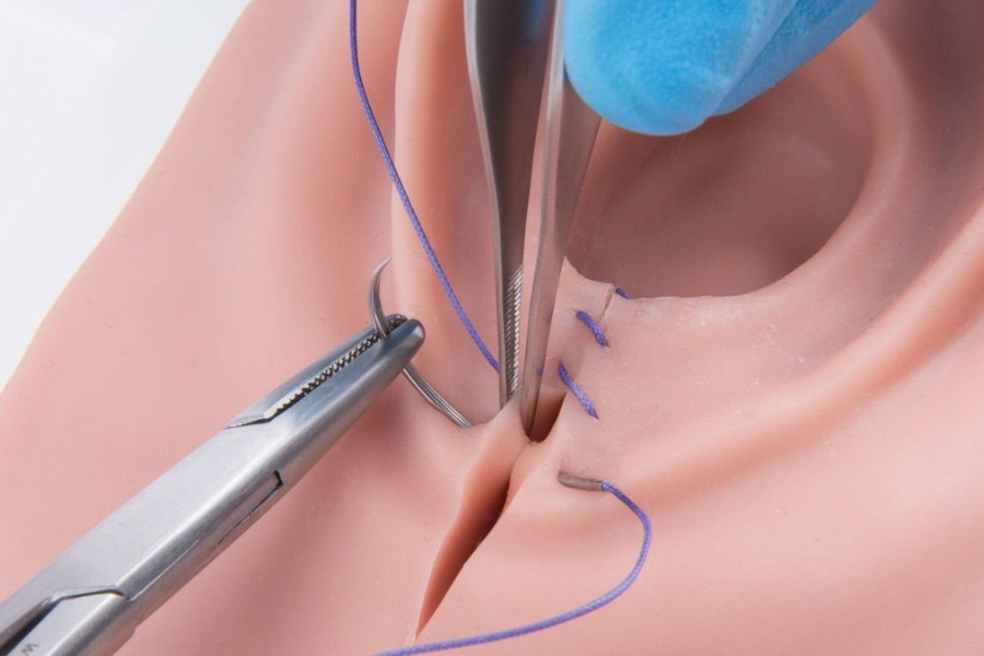 khâu thẩm mỹ tầng sinh môn