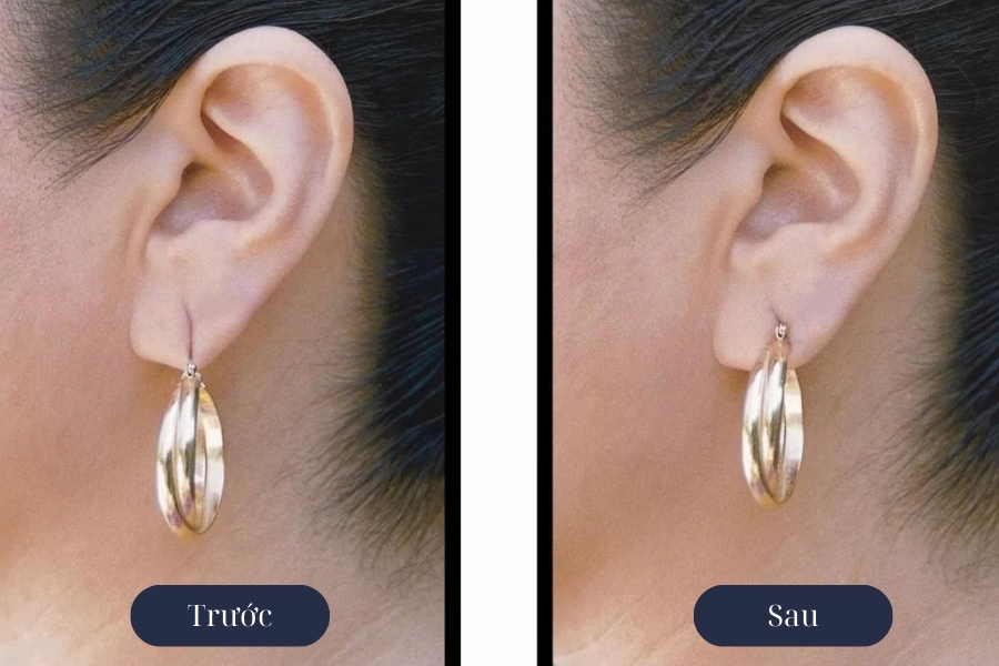 Khâu lỗ tai thẩm mỹ khắc phục tình trạng rách dái tai nhẹ nhàng, nhanh chóng