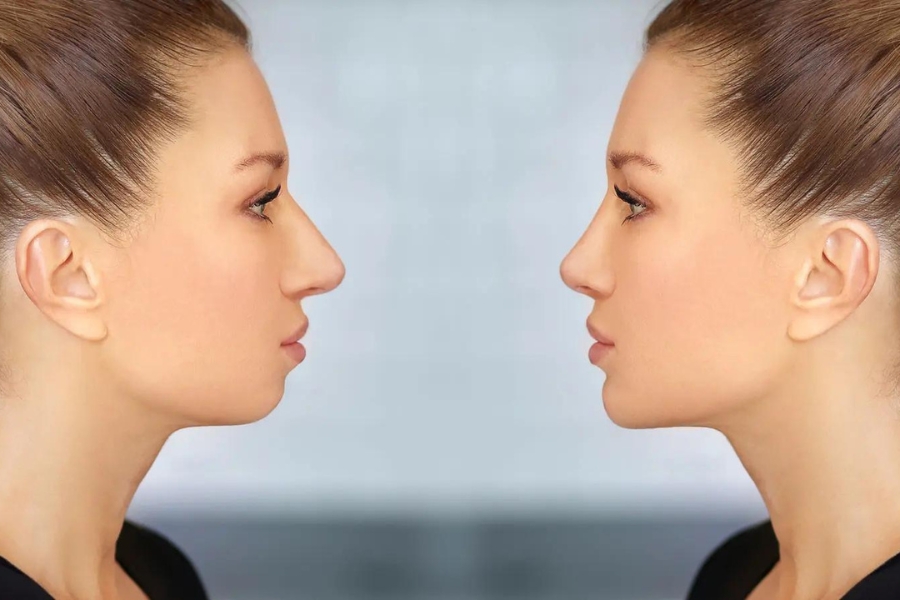 Độn cằm khắc phục khuyết điểm, giúp đường nét cân đối, hài hòa hơn