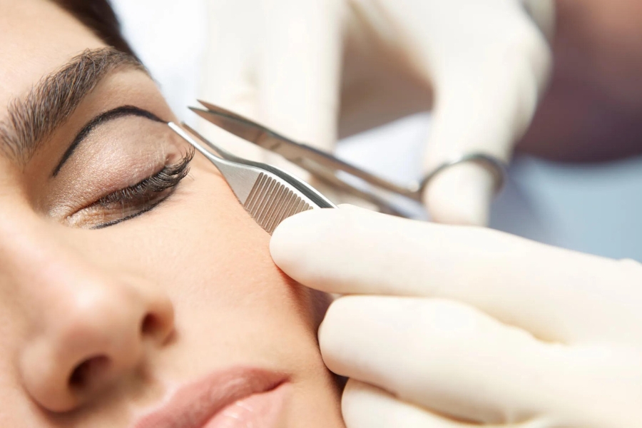 Bác sĩ xác định vị trí cắt mí mắt