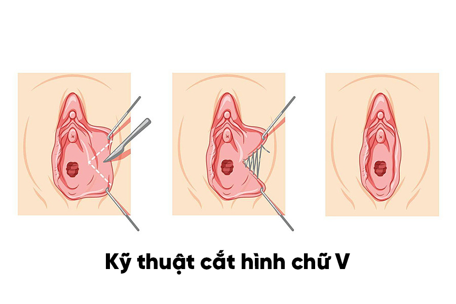 Phẫu thuật tạo hình môi bé bằng kỹ thuật chữ V