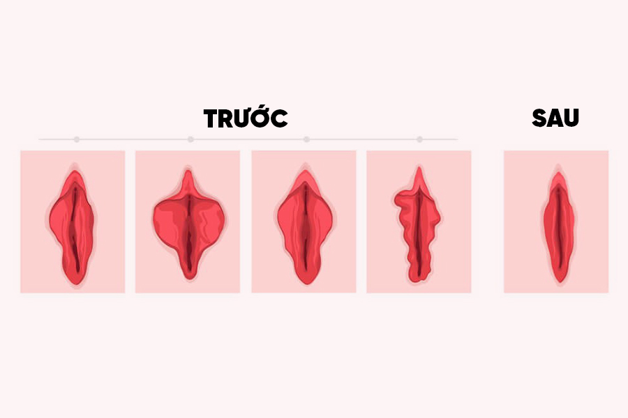 cắt tạo hình môi bé