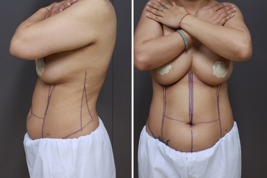 Những người xuất hiện tình trạng mỡ thừa nhiều vùng trên cơ thể phù hợp hút mỡ toàn thân