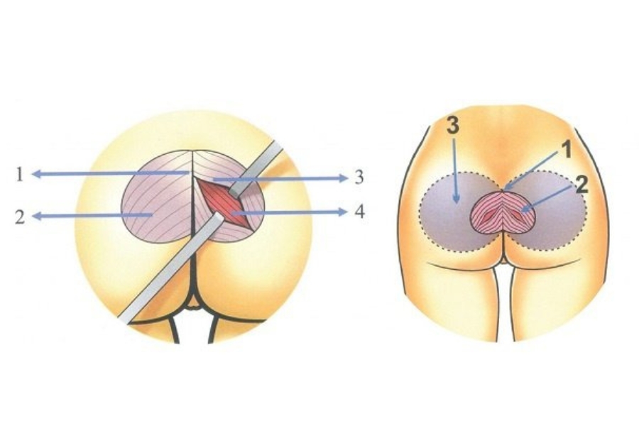 Nâng mông nội soi sử dụng thiết bị nội soi để đặt túi độn vào bên trong
