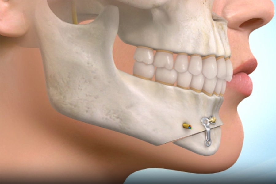 Kỹ thuật trượt cằm tạo dáng cằm V line