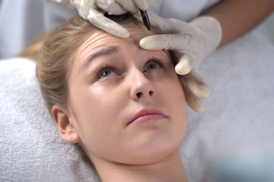 Tiến hành đo vẽ vị trí thực hiện căng da trán