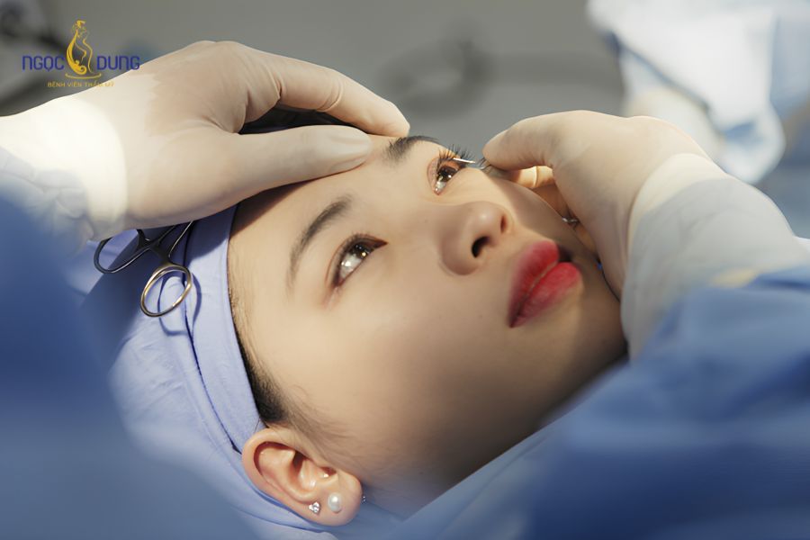 Phẫu thuật cắt mí mắt là gì? Có nên cắt mắt 2 mí không? 15 Quy trình cắt mí mắt khép kín chuẩn y khoa đảm bảo tính an toàn và độ chính xác tuyệt đối