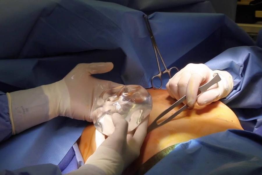 Phẫu thuật đặt túi ngực vào khoang ngực