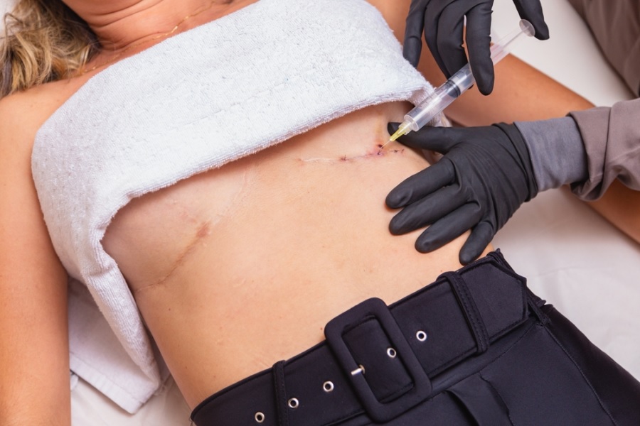 Phương pháp cắt bỏ một phần vùng ngực phì đại dành cho trường hợp phì đại nặng