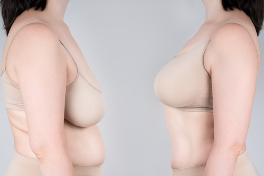 Những người có tuyến vú lớn bất thường nên thực hiện thu nhỏ ngực