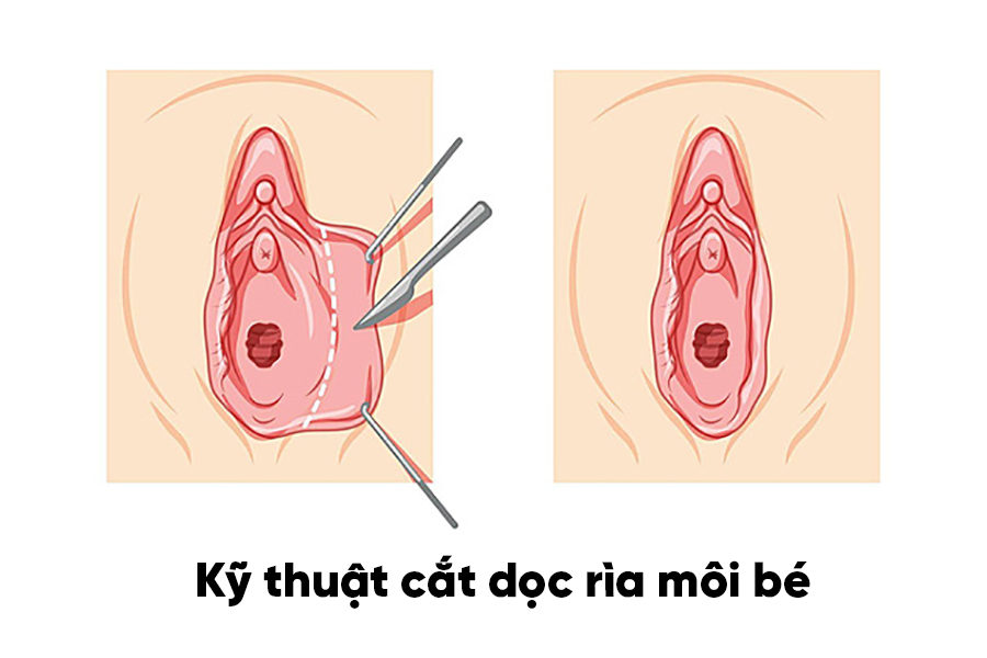 Kỹ thuật cắt dọc rìa môi bé khá phổ biến, tuy nhiên còn mang lại nhiều nhược điểm