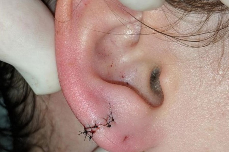 Tiểu phẫu vá lỗ tai là gì