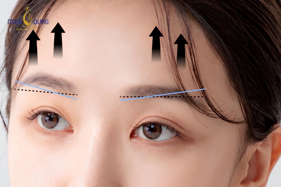 Treo chân mày là giải pháp hoàn hảo giúp khắc phục triệt để tình trạng sụp mí mắt do lão hóa gây ra