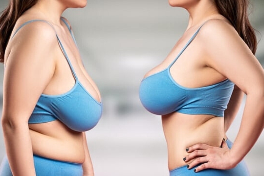 Treo ngực sa trễ cấp độ 3