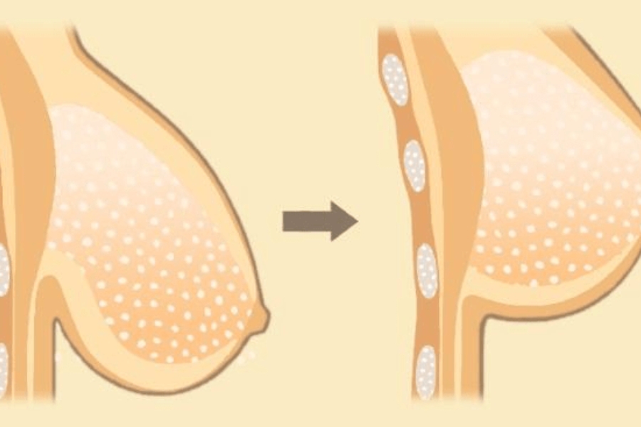 Treo sa trễ là gì