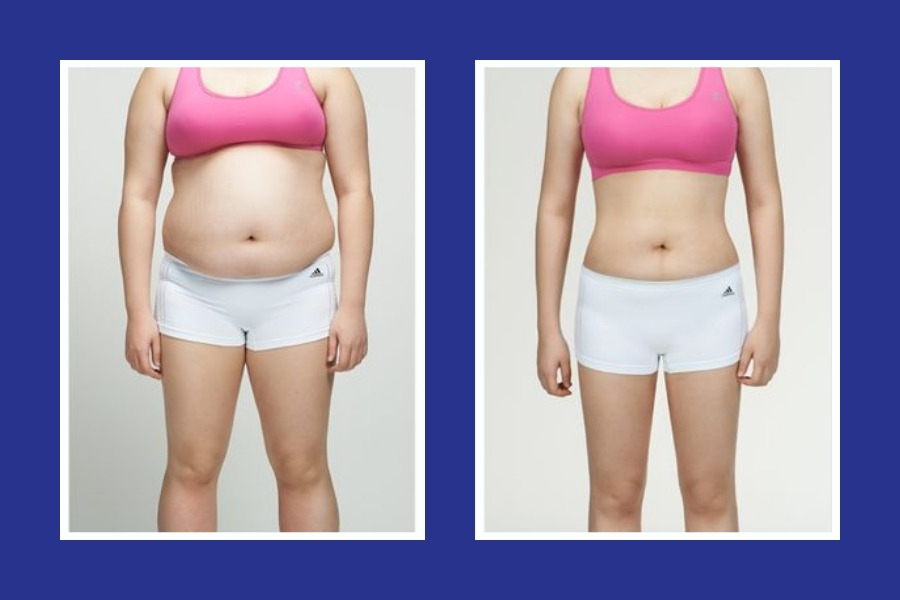 Ưu điểm nổi bật của nâng ngực bằng mỡ tự thân là vừa tăng vòng 1 vừa giúp giảm mỡ tại các vùng đùi, bụng,...