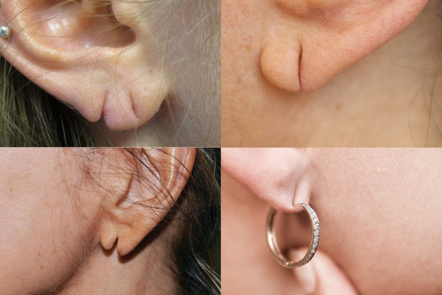 Vá lỗ tai bao nhiêu tiền còn tùy thuộc vào tình trạng cụ thể của lỗ tai