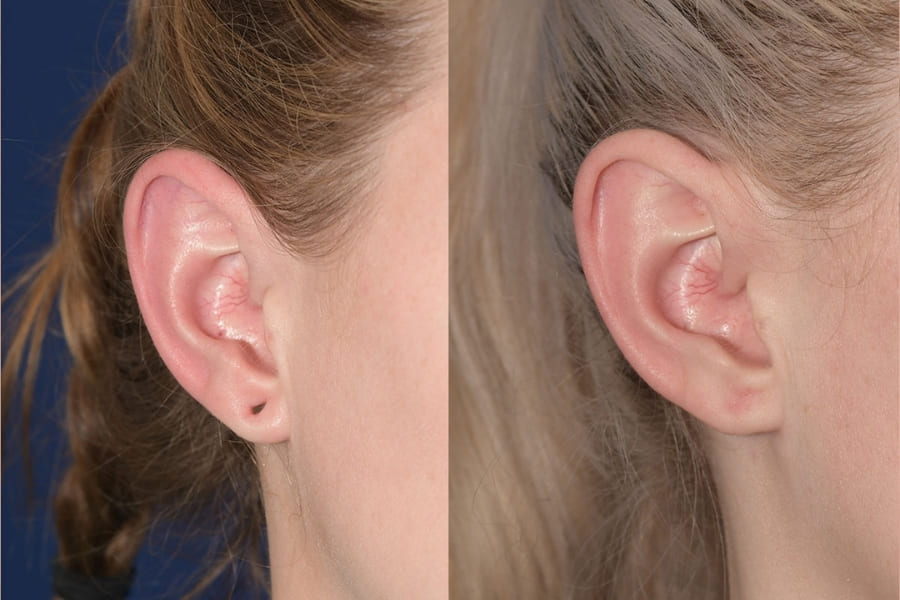 Vá lỗ tai có thể xuất hiện các cơn đau và khó chịu trong 1, 2 ngày đầu sau tiểu phẫu