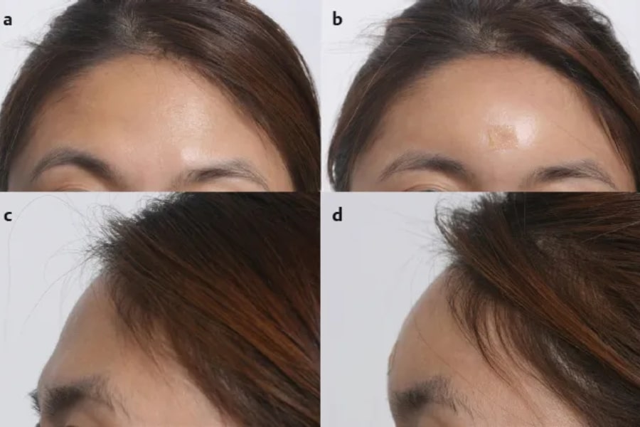 Quá trình phục hồi sau cấy mỡ trán