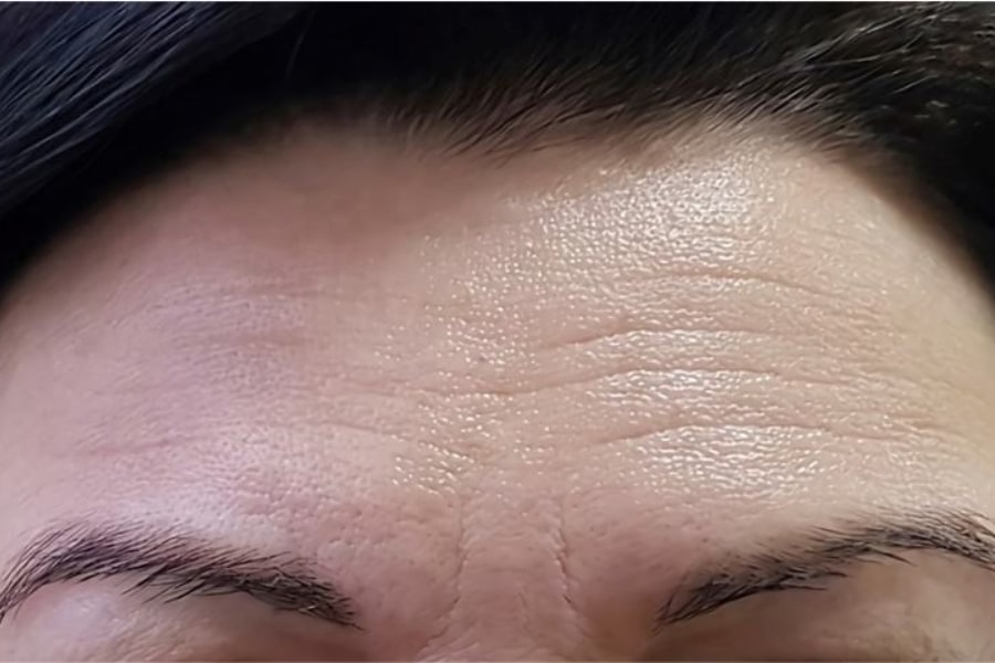 Đối tượng nào phù hợp với phương pháp cấy mỡ vùng trán?