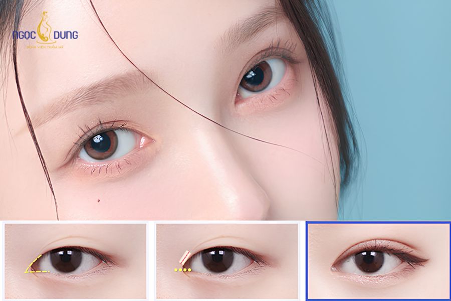 Mở góc mắt là gì? Ưu nhược điểm của cắt mí mở hốc mắt 13 Bác sĩ tiến hành đo đạc tỷ lệ nếp rẻ quạt thực tế để đưa ra chỉ định phù hợp cho từng khách hàng