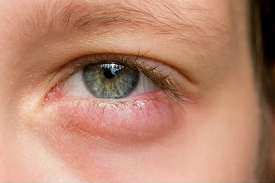 Co rút mí mắt là một biến chứng nghiêm trọng có thể xảy ra sau khi cắt mí mắt dưới