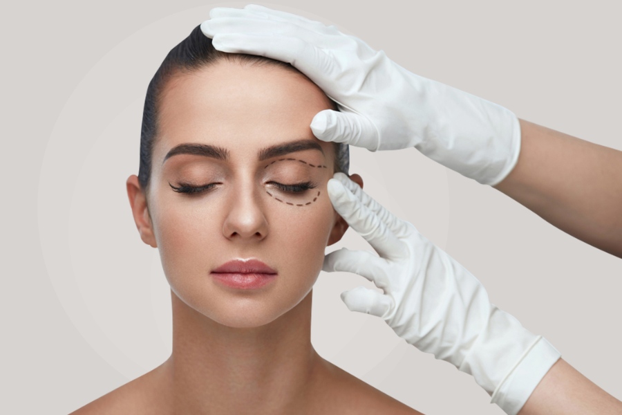 Bác sĩ tiến hành đo vẽ vùng cần lấy mỡ mí mắt trên