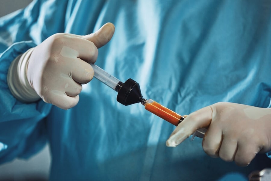 Cấy mỡ trán là như thế nào?