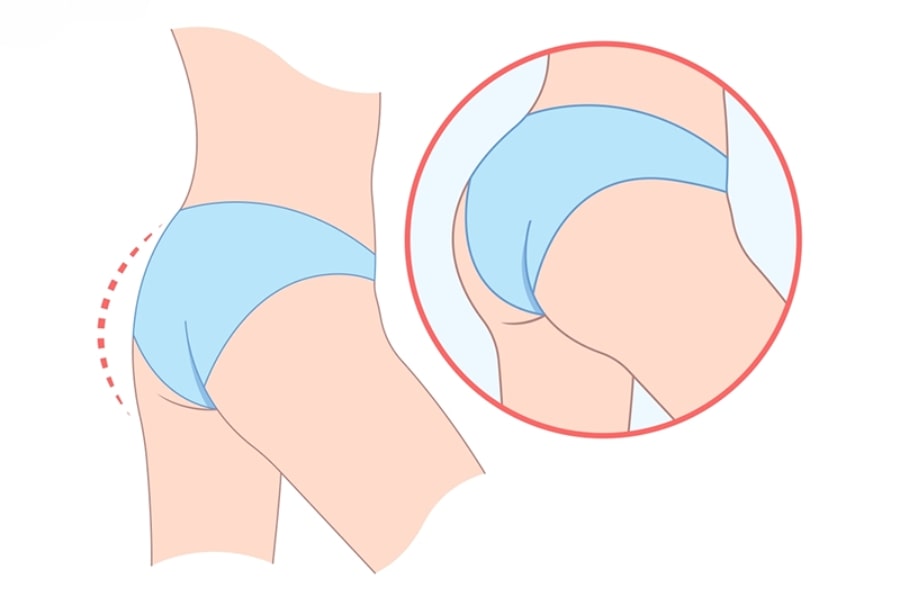 Những đối tượng phù hợp với bơm mông bằng mỡ tự thân