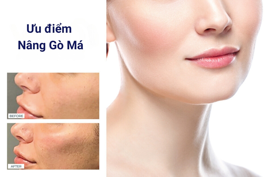 Ưu điểm khi thực hiện nâng gò má là gì?