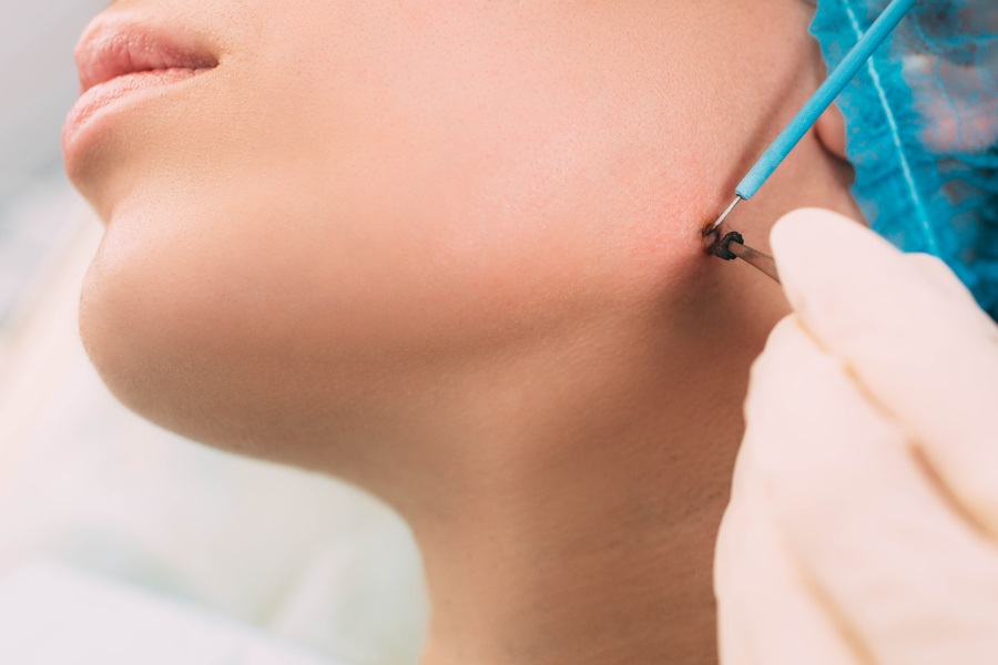 Tẩy nốt ruồi bằng thuốc chấm