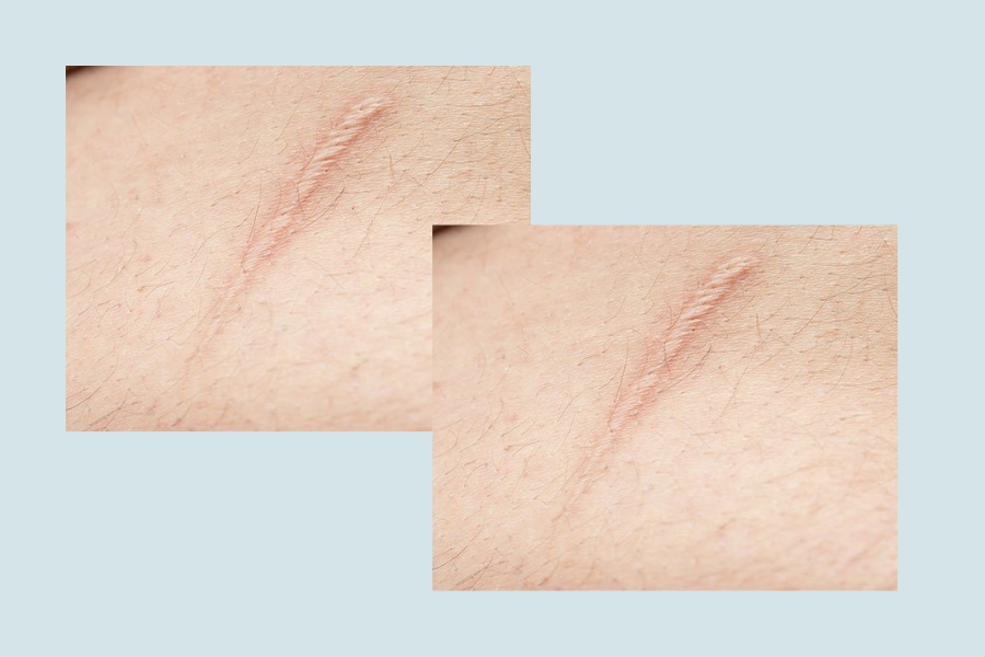 Kiêng khem đúng cách sẽ không để lại sẹo xấu sau khi cắt da thừa nách