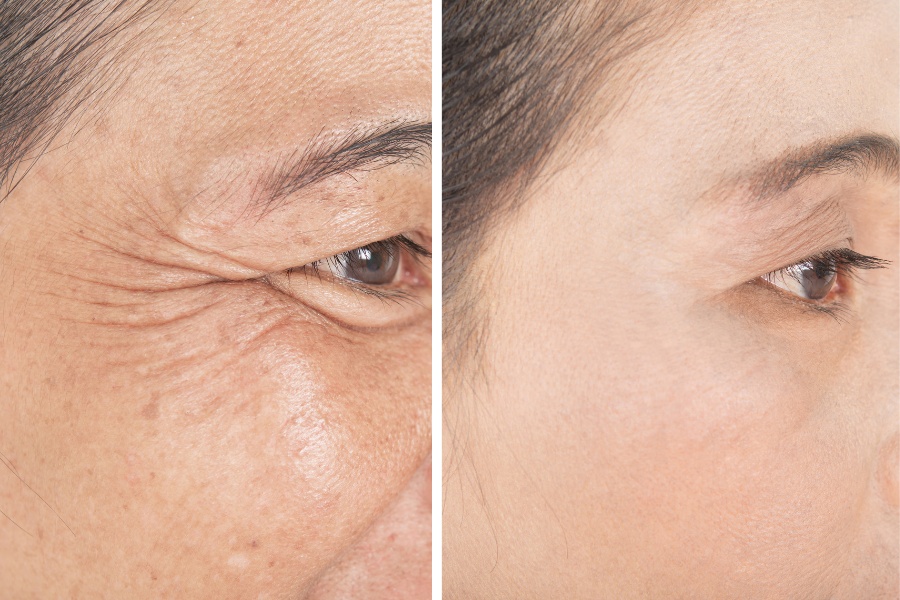 Chi phí cắt mí mắt dưới không có mức giá cố định mà phụ thuộc vào nhiều yếu tố khác nhau