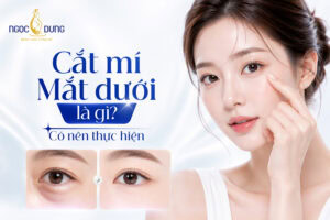 Cắt mí dưới