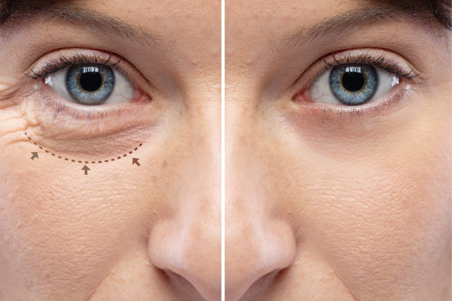 Cắt mí mắt dưới là thủ thuật giúp loại bỏ da thừa, mỡ bọng và nếp nhăn ở vùng mắt dưới