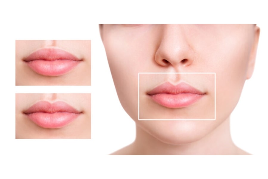 Việc cắt môi trái tim không đúng kỹ thuật có thể dẫn đến sẹo và các biến chứng khác