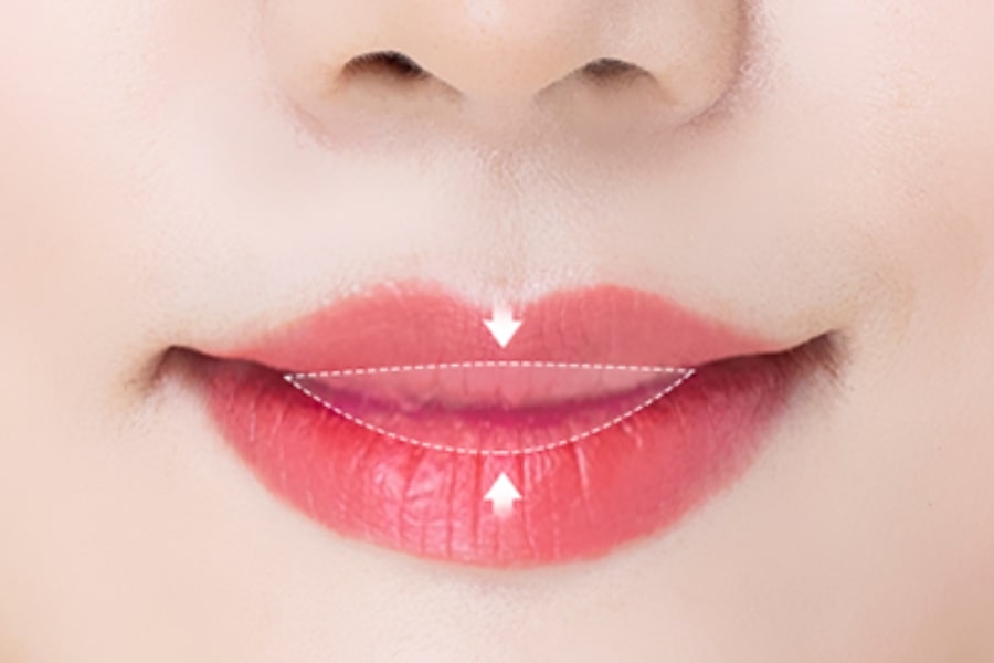 Quyết định có nên thẩm mỹ môi trái tim hay không phụ thuộc vào nhiều yếu tố khác nhau