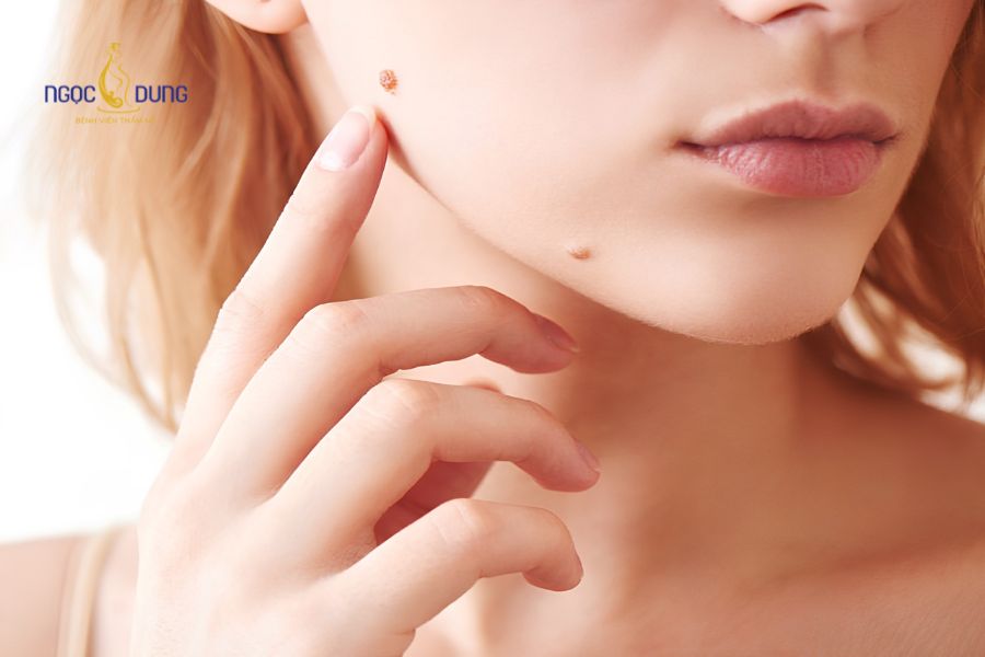 Tiểu phẫu cắt nốt ruồi - Bí quyết cho làn da đẹp không tì vết 2 Không nên tự tẩy xóa nốt ruồi tại nhà bởi tiềm ẩn nhiều rủi ro