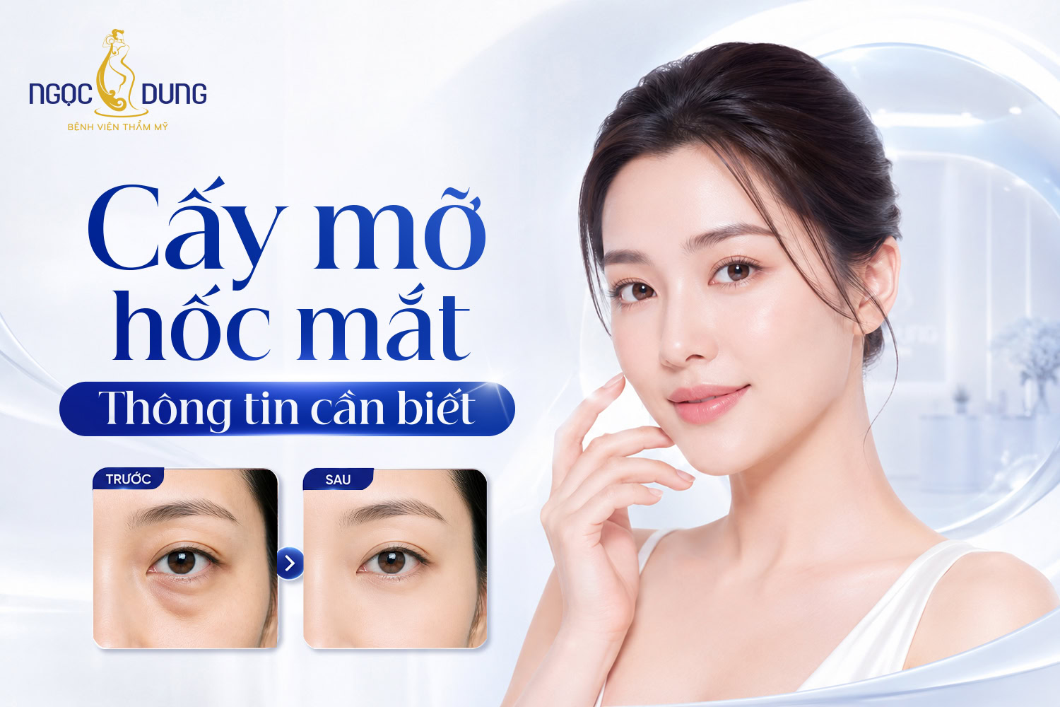 Cấy mỡ hốc mắt
