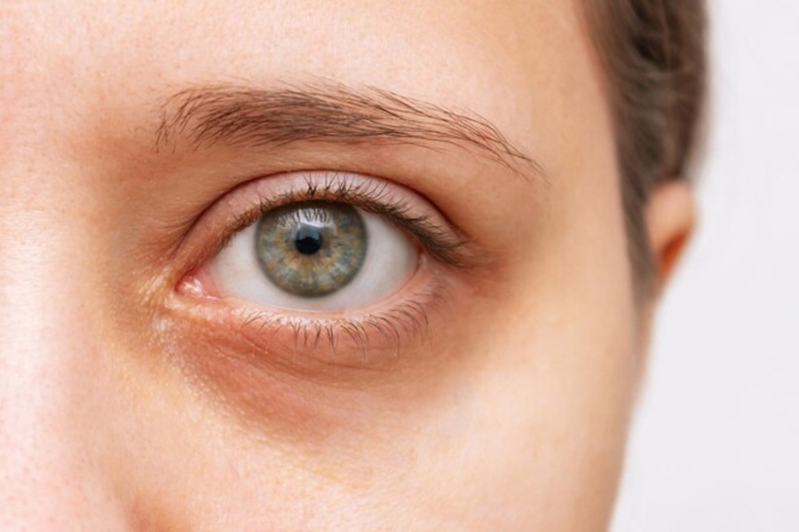 Khi thực hiện cấy mỡ, bạn sẽ được gây tê vì vậy sẽ không cảm thấy đau