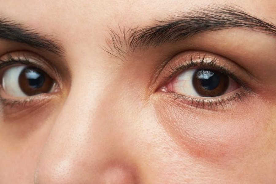 cấy mỡ hốc mắt sâu