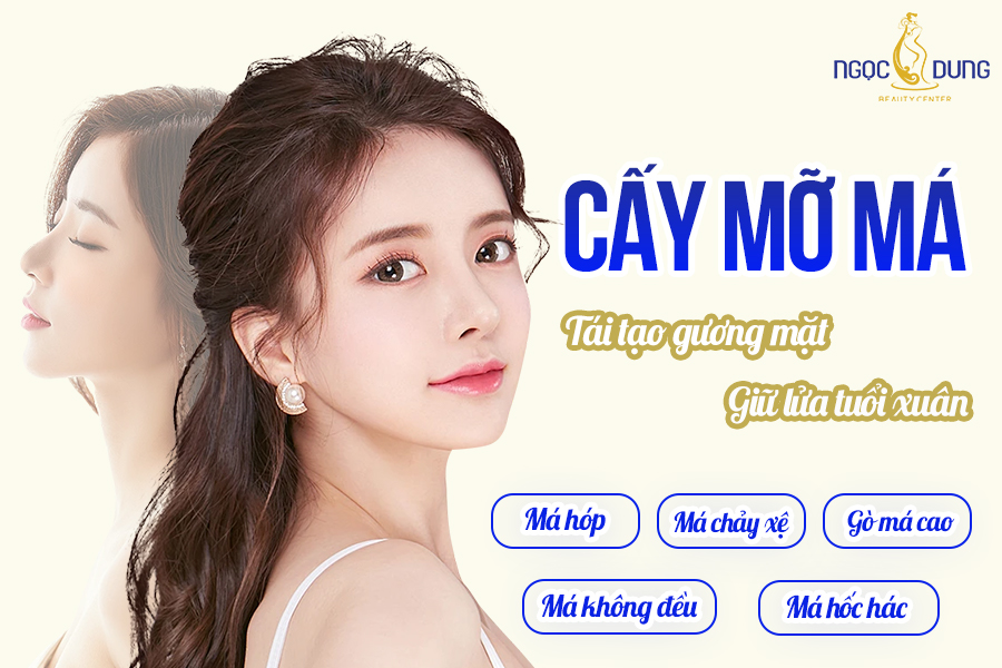 cấy mỡ má