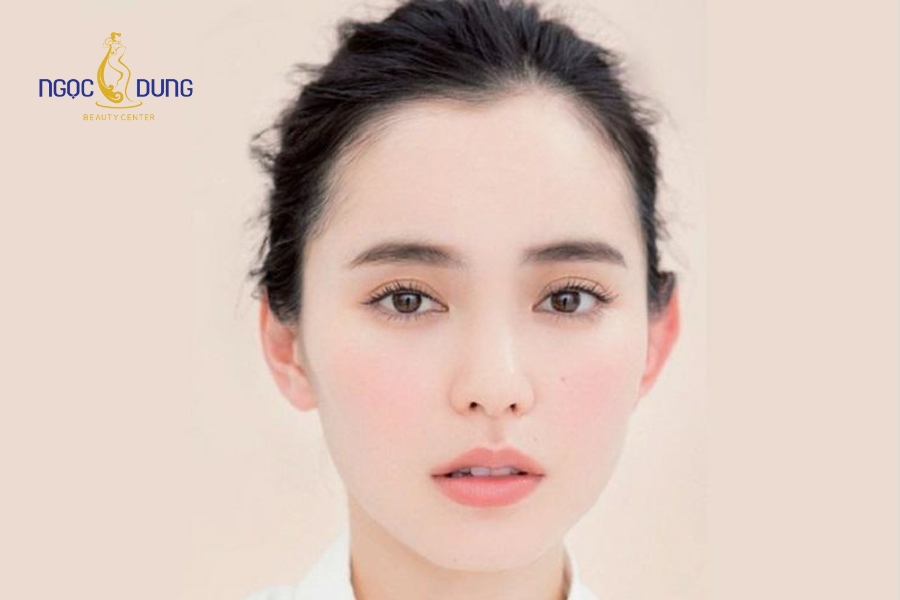 Cấy mỡ mí trên