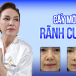 Bí quyết cấy mỡ rãnh cười - Tạm biệt khuôn mặt già nua