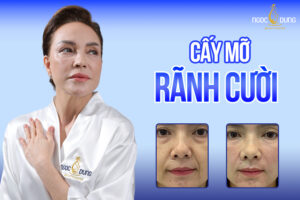 Bí quyết cấy mỡ rãnh cười - Tạm biệt khuôn mặt già nua