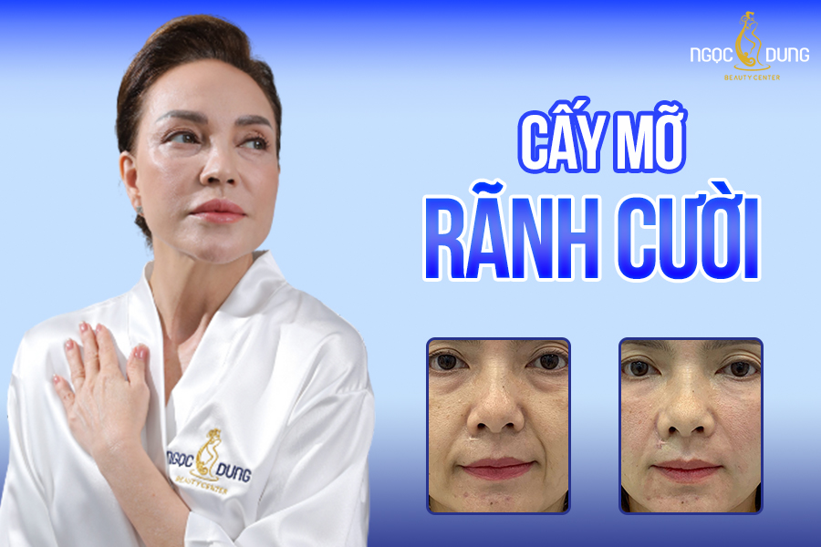 Bí quyết cấy mỡ rãnh cười - Tạm biệt khuôn mặt già nua