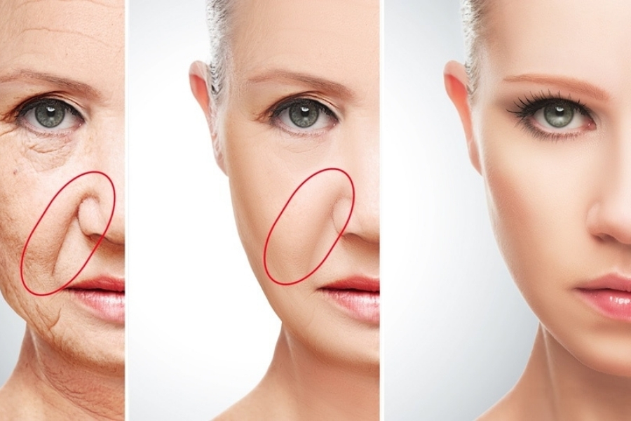 Cấy mỡ rãnh mũi má là giải pháp hiệu quả để xóa rãnh cười sâu và các dấu hiệu lão hóa tại vùng này