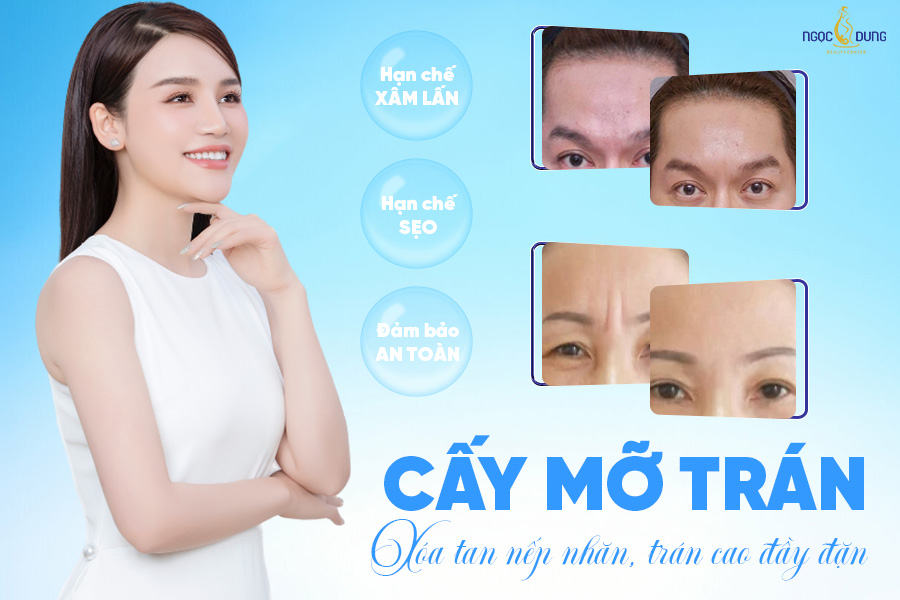 Cấy mỡ trán: Bí quyết tạm biệt trán lõm và xóa mờ các nếp nhăn